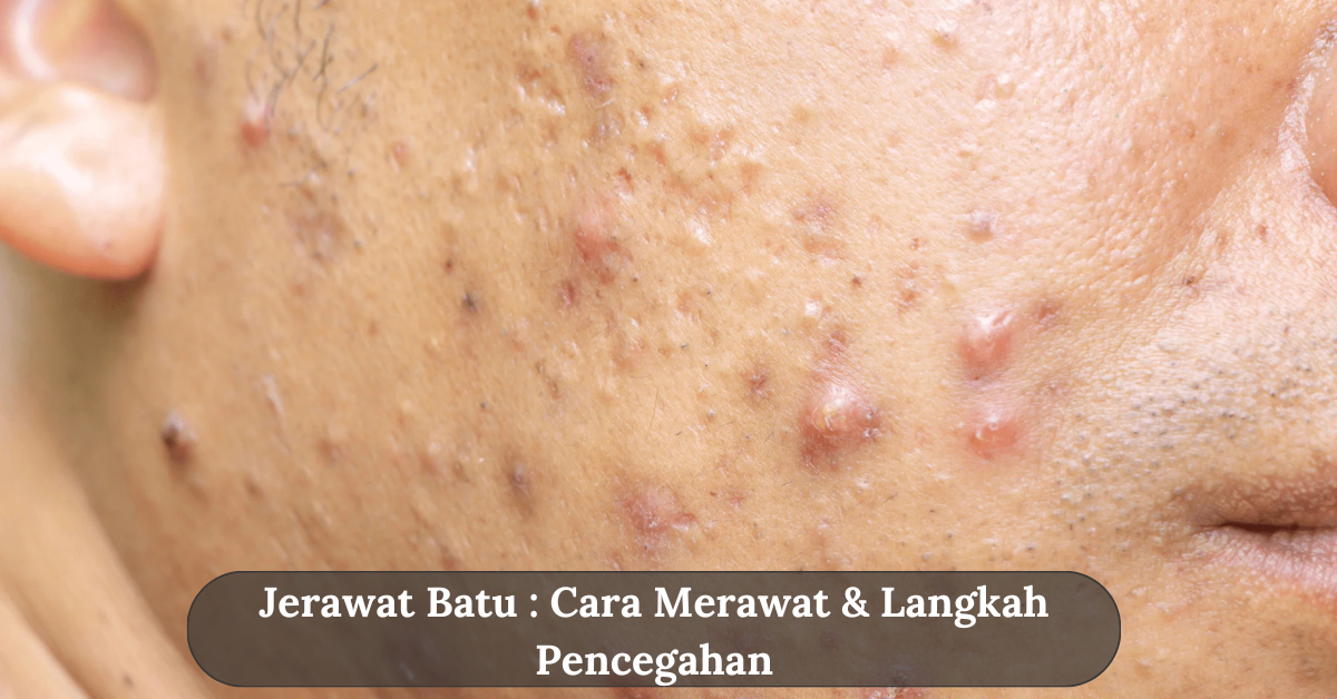 Stone acne: how to take care and prevention stages - Neatsoftwaresolutions